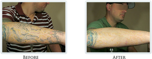 ... Removal Process Portland OR - Tattoo Removal Procedure Portland Oregon