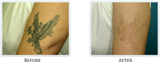 Portland - Laser Tattoo Removal Process Portland OR - Tattoo Removal ...