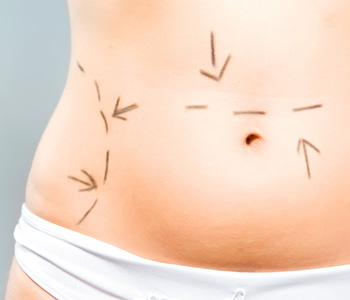 Closeup photo of a Caucasian woman's abdomen marked with lines for abdominal cellulite correction cosmetic surgery