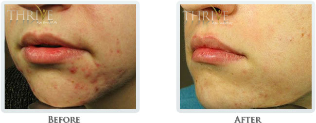 Acne Scars Reduction Portland OR - Laser Acne Treatments