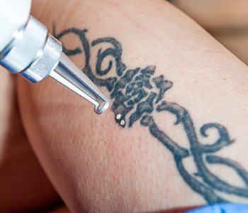 Effective tattoo removal from Doctor in Portland, OR