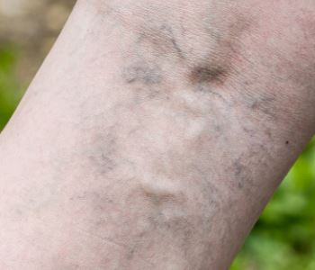Spider veins treatment form Vascular Specialists doctor in Portland