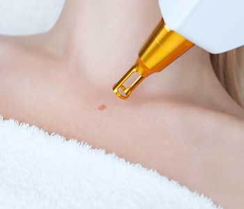 Choosing the right treatment - Laser treatment options in Portland OR
