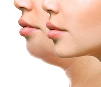 Kybella treatment for double chin in Portland, OR