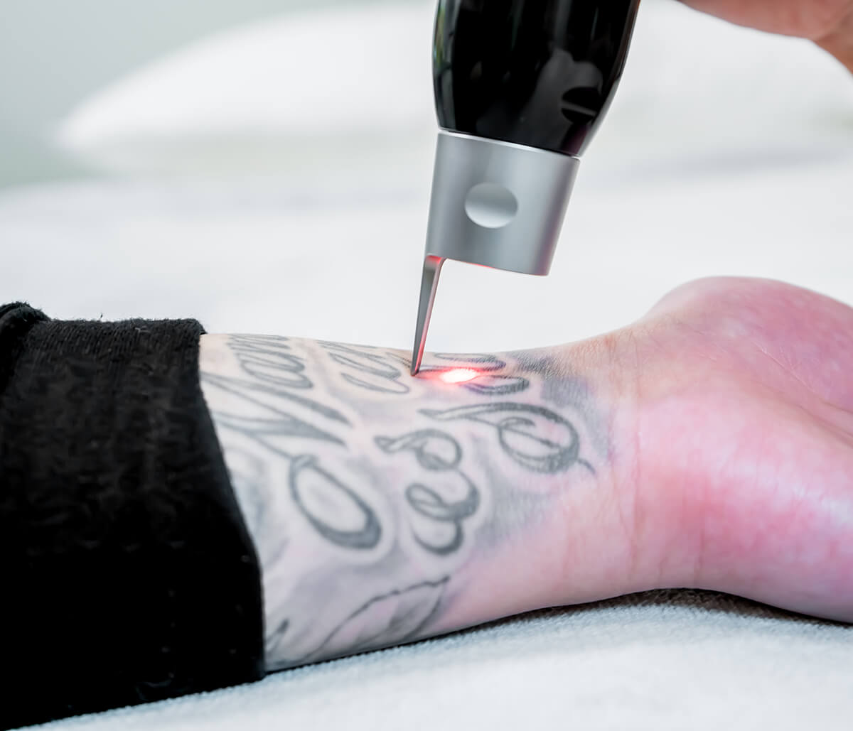 Tattoo Removal Cost in Portland OR Area