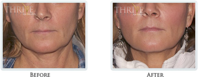 Non Surgical Facelift Before and After 11