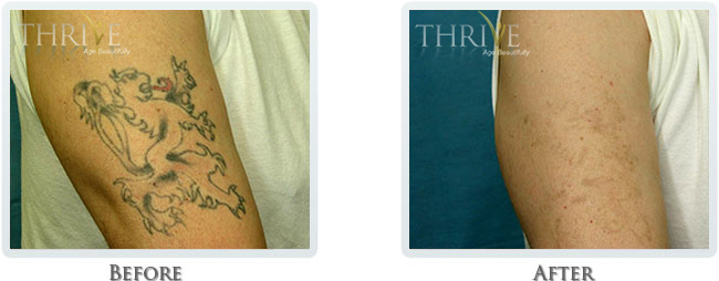 Tattoo Removal Before and After 02