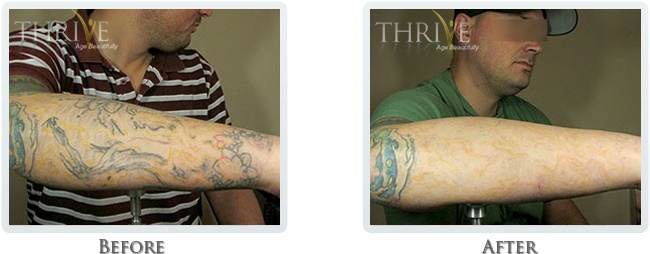 Tattoo Removal Before and After 01