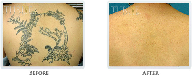 Tattoo Removal Before and After 03